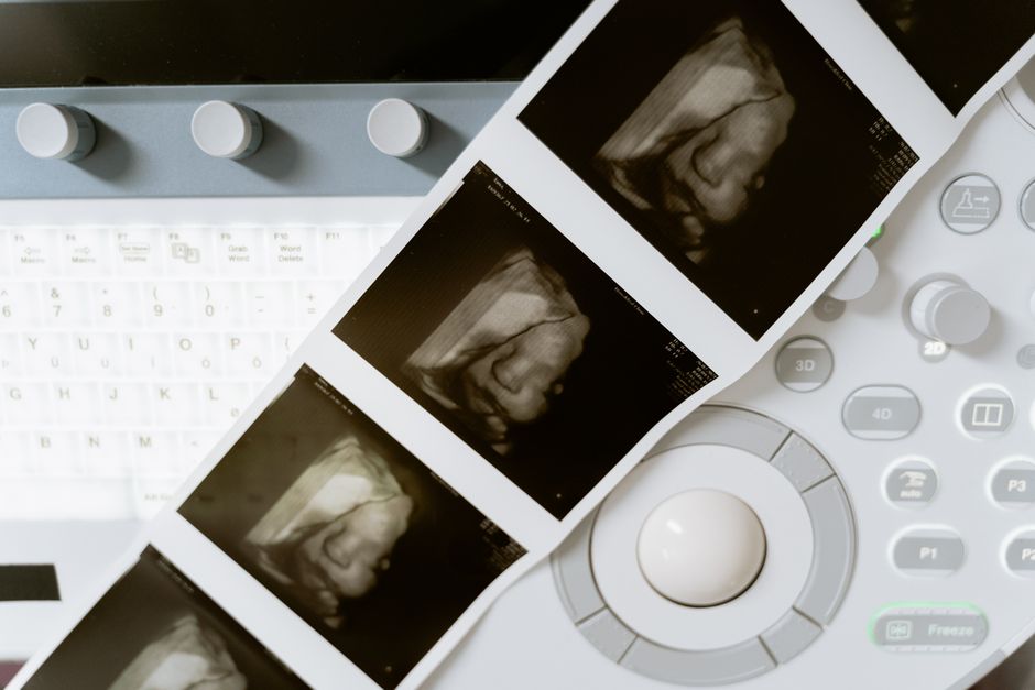obstetric ultrasound ultrasound at Nucleus Scans Pathanapuram